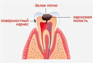 Ступеня карієсу розвиток, ступеня активності і небезпека для людини (мірою карієсу) Ступеня карієсу розвиток, ступеня активності і небезпека для людини