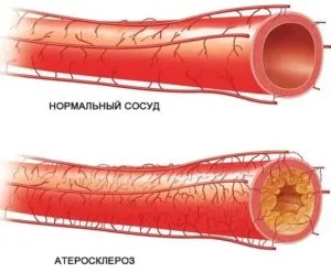 Стенозуючий атеросклероз що це, лікування (лікування) Стенозуючий атеросклероз що це, лікування