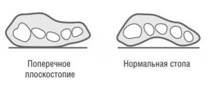 Ступня людини будова, особливості та її деформація (ступня) Ступня людини будова, особливості та її деформація