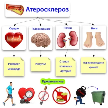 Стенозуючий атеросклероз артерій - нижніх кінцівок, сонних, коронарних, каротидних артерій,