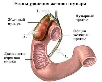 Видалений жовчний міхур - модна красива (видалення жовчного міхура) Видалений жовчний міхур - модна красива