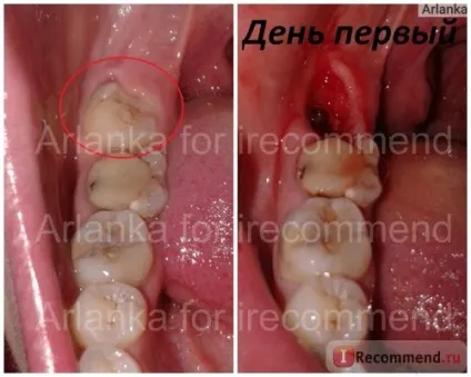 Видалення зубів - «обов'язково видаляти здорові зуби перед установкою брекетів ніхто вам на цей (зубів) Видалення зубів - «обов'язково видаляти здорові зуби перед установкою брекетів ніхто вам на цей