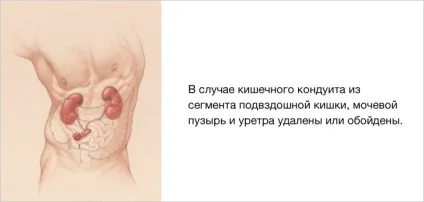 Уростома, hollister