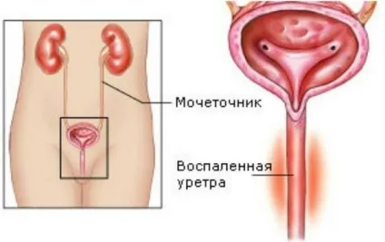 Уретрит у дітей симптоми, лікування, препарати, профілактика, відео (уретрит дітей лікування симптоми причини дитини профілактика запалення інфекційний алергічний препарати антибіотик фітотерапія ознаки) Уретрит у дітей симптоми, лікування, препарати, профілактика, відео