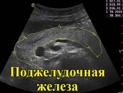 Узі підшлункової залози підготовка, таблиця з нормами, розшифровка результатів у жінок (підшлункової) Узі підшлункової залози підготовка, таблиця з нормами, розшифровка результатів у жінок