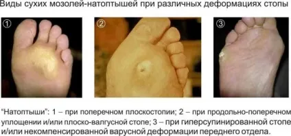 Види мозолів, які вони можуть бути і як виглядають водяна, чорна, м'яка, різновиди сухий (мозоль з гноєм) Види мозолів, які вони можуть бути і як виглядають водяна, чорна, м'яка, різновиди сухий