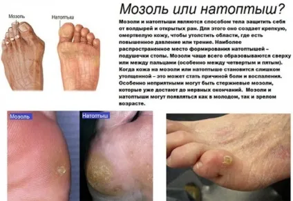 Види мозолів, які вони можуть бути і як виглядають водяна, чорна, м'яка, різновиди сухий (цвяховий мозоль) Види мозолів, які вони можуть бути і як виглядають водяна, чорна, м'яка, різновиди сухий