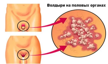Пухирі на статевому члені основні причини появи (члені) Пухирі на статевому члені основні причини появи