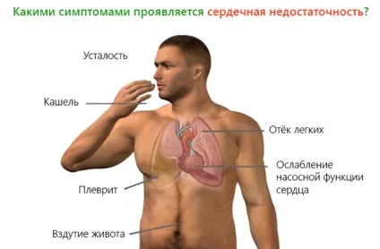 Раптова смерть від серцевої недостатності причини (недостатності) Раптова смерть від серцевої недостатності причини