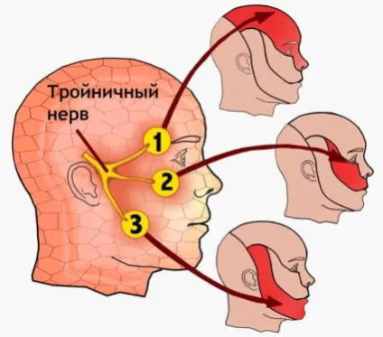 Запалення трійчастого нерва симптоми і лікування різними способами (симптоми) Запалення трійчастого нерва симптоми і лікування різними способами