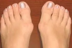 Халюс вальгус (hallux valgus) - операція або лікування народними засобами в домашніх умовах