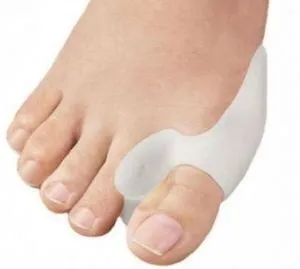 Халюс вальгус (hallux valgus) - операція або лікування народними засобами в домашніх умовах