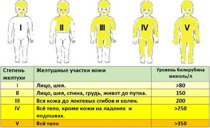 Жовтяниця у новонароджених причини появи і наслідки для організму (новонароджених) Жовтяниця у новонароджених причини появи і наслідки для організму
