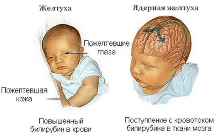 Жовтяниця у новонароджених причини появи і наслідки для організму (жовтяниця у новонароджених) Жовтяниця у новонароджених причини появи і наслідки для організму
