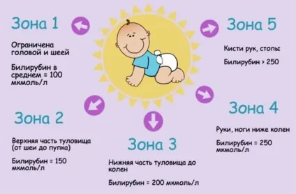 Жовтяниця у новонароджених причини і наслідки (жовтяниця) Жовтяниця у новонароджених причини і наслідки