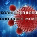Менінгіома головного мозку лікування без операції і видалення менінгіоми, прогноз життя (видалення) Менінгіома головного мозку лікування без операції і видалення менінгіоми, прогноз життя