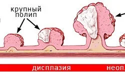 Метастазування при раку шлунка (про шлунку) Метастазування при раку шлунка