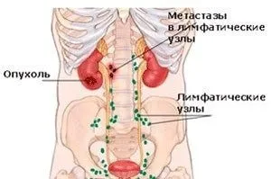 Метастазування раку шлунка - шляхи поширення, особливості (раку) Метастазування раку шлунка - шляхи поширення, особливості
