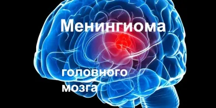 Менінгіома головного мозку лікування без операції і видалення менінгіоми, прогноз життя (головного) Менінгіома головного мозку лікування без операції і видалення менінгіоми, прогноз життя