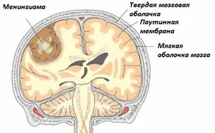 Менінгіома головного мозку лікування без операції і видалення менінгіоми, прогноз життя (видалення) Менінгіома головного мозку лікування без операції і видалення менінгіоми, прогноз життя