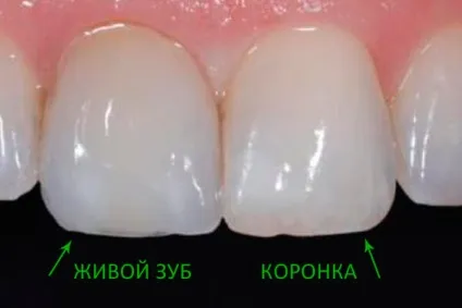Металокерамічні коронки на передні зуби що потрібно знати
