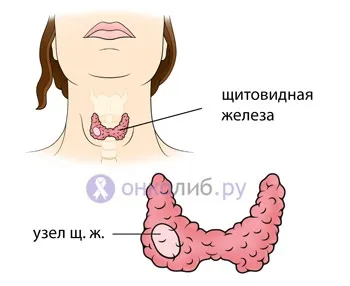 Аденома щитовидної залози, фолікулярна пухлина, токсична (залози) Аденома щитовидної залози, фолікулярна пухлина, токсична
