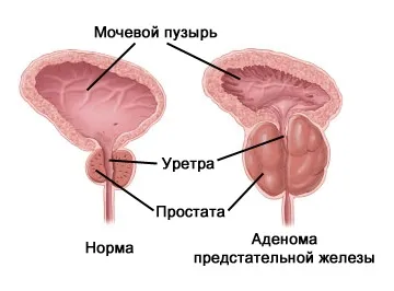 Аденома передміхурової залози 3 ступеня обстеження і лікування (ознаки) Аденома передміхурової залози 3 ступеня обстеження і лікування