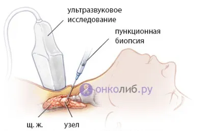Аденома щитовидної залози, фолікулярна пухлина, токсична (залози) Аденома щитовидної залози, фолікулярна пухлина, токсична