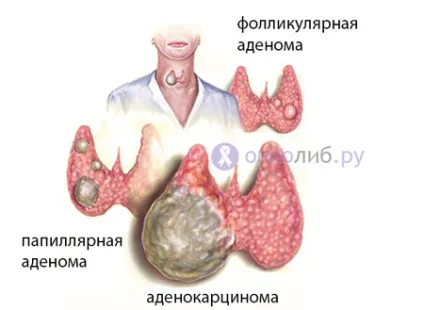 Аденома щитовидної залози, фолікулярна пухлина, токсична (пухлина) Аденома щитовидної залози, фолікулярна пухлина, токсична