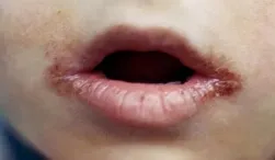 Ангуліт - лікування, причини, симптоми, фото ангуліта у дітей (ангуліт) Ангуліт - лікування, причини, симптоми, фото ангуліта у дітей