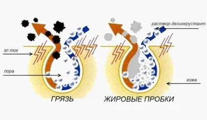 Апаратна дезінкрустація (гальванічна чистка обличчя) що це, механізм дії гальванічного (дезінкрустація що це) Апаратна дезінкрустація (гальванічна чистка обличчя) що це, механізм дії гальванічного