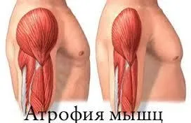 Атрофія симптоми, лікування, опис