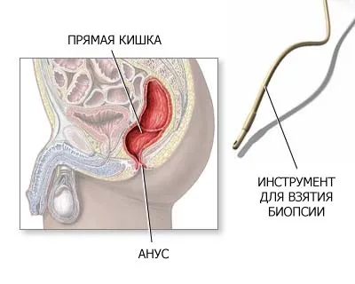 Біопсія прямої кишки - здоров'я інфо (прямий) Біопсія прямої кишки - здоров'я інфо