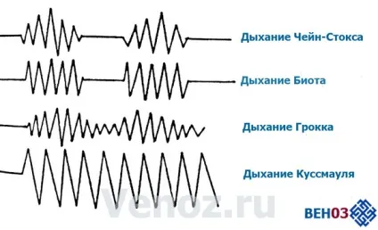 Безсоння лікування порушення сну після інсульту, лікарські ср-ва (лікарські) Безсоння лікування порушення сну після інсульту, лікарські ср-ва