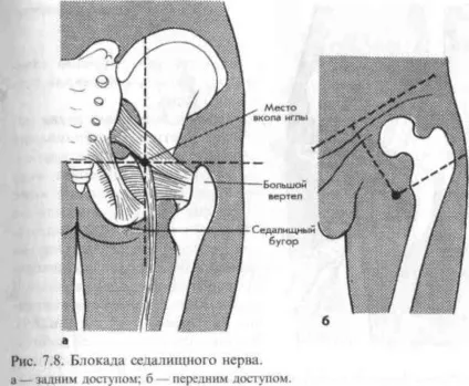 Блокада сідничного нерва - фото, відео (затисканні сідничного нерва) Блокада сідничного нерва - фото, відео