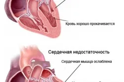 Болі в серці і їх симптоми