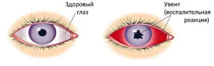Біль в очах при русі очного яблука причини і лікування в очницях, при натисканні, (русі) Біль в очах при русі очного яблука причини і лікування в очницях, при натисканні,