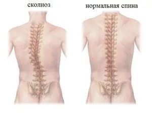 Чим небезпечний сколіоз і його наслідки, ускладнення викривлення грудного відділу (небезпечний) Чим небезпечний сколіоз і його наслідки, ускладнення викривлення грудного відділу