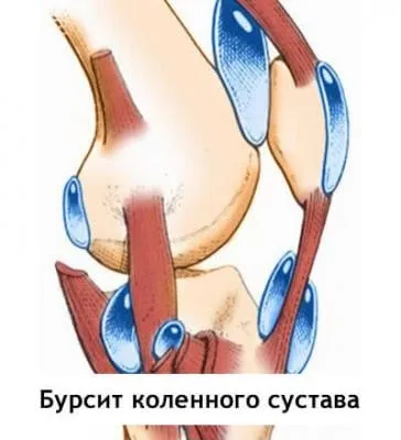 Бурсит колінного суглоба симптоми і лікування в домашніх умовах, фото (лікування) Бурсит колінного суглоба симптоми і лікування в домашніх умовах, фото