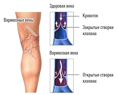 Центр (клініка) флебології в москві, центр лікування варикозу і варикозного розширення вен (москві) Центр (клініка) флебології в москві, центр лікування варикозу і варикозного розширення вен
