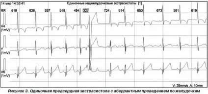 Часті екстрасистоли причини виникнення, лікування і профілактика (екстрасистоли) Часті екстрасистоли причини виникнення, лікування і профілактика