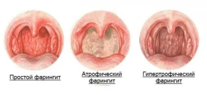 Чим лікувати фарингіт у дорослих препарати, в домашніх умовах, антибіотики, швидко, симптоми, (антибіотики) Чим лікувати фарингіт у дорослих препарати, в домашніх умовах, антибіотики, швидко, симптоми,