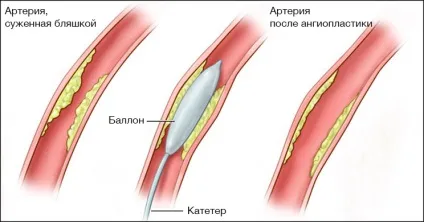 Часті питання про балонної ангіопластики, стент, стентування та відповіді на них (стент) Часті питання про балонної ангіопластики, стент, стентування та відповіді на них