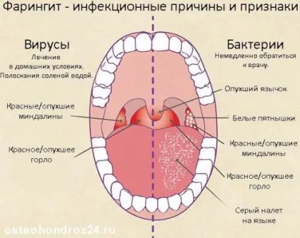 Чим лікувати фарингіт у дорослих препарати, в домашніх умовах, антибіотики, швидко, симптоми, (препарати) Чим лікувати фарингіт у дорослих препарати, в домашніх умовах, антибіотики, швидко, симптоми,