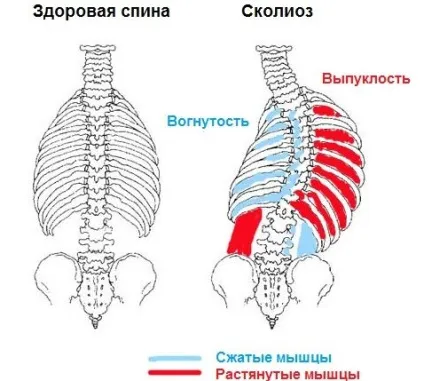 Чим небезпечний сколіоз і чим він загрожує, як жити з ним, до чого призводять ускладнення сколіозу (сколіоз) Чим небезпечний сколіоз і чим він загрожує, як жити з ним, до чого призводять ускладнення сколіозу