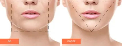 Dental face lifting