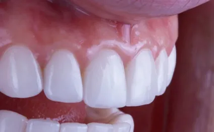 Dental face lifting