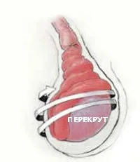 Міома на ніжці