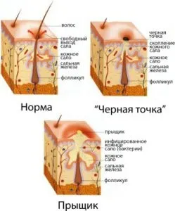 Свербить обличчя і з'являються прищі (прищі) Свербить обличчя і з'являються прищі