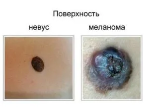 Що буде якщо здерти родимку - фото, ускладнення, рекомендації (родимку) Що буде якщо здерти родимку - фото, ускладнення, рекомендації